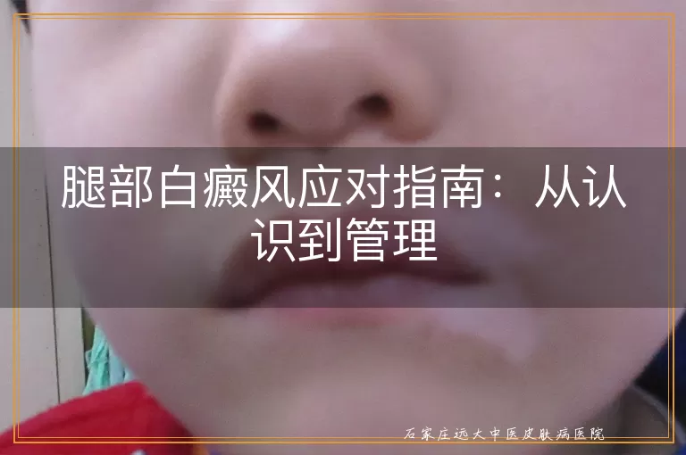 腿部白癜风应对指南：从认识到管理