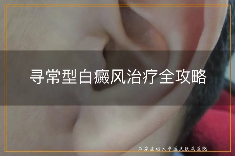 寻常型白癜风治疗全攻略