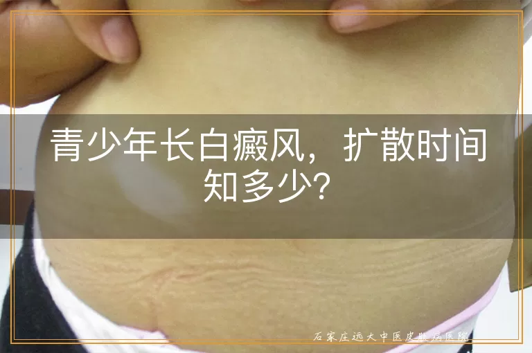 青少年长白癜风，扩散时间知多少？