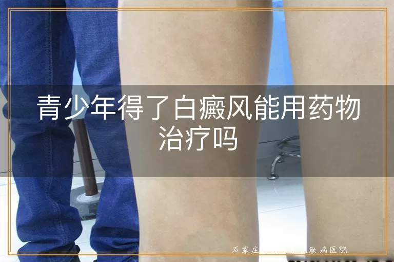 青少年得了白癜风能用药物治疗吗