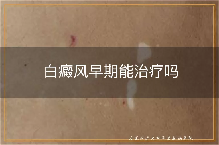 白癜风早期能治疗吗
