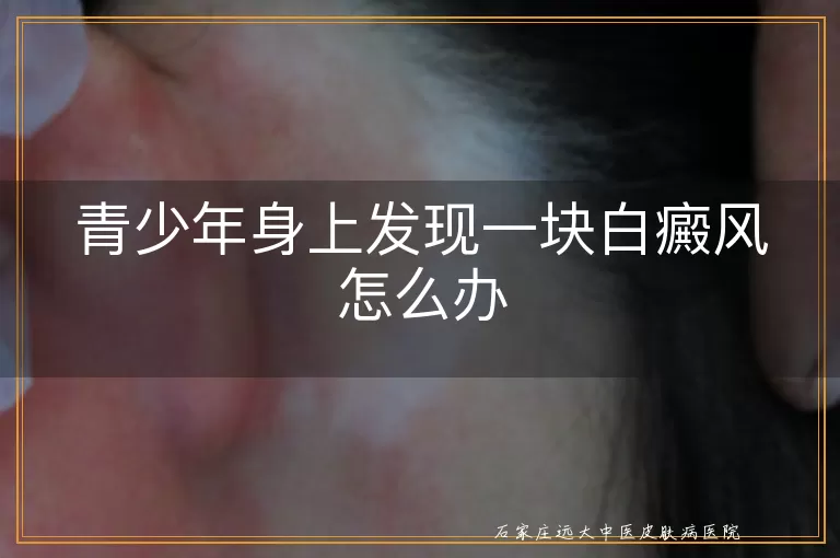 青少年身上发现一块白癜风怎么办
