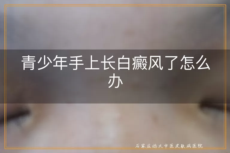 青少年手上长白癜风了怎么办