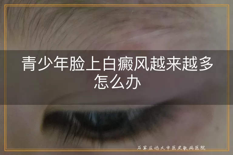 青少年脸上白癜风越来越多怎么办