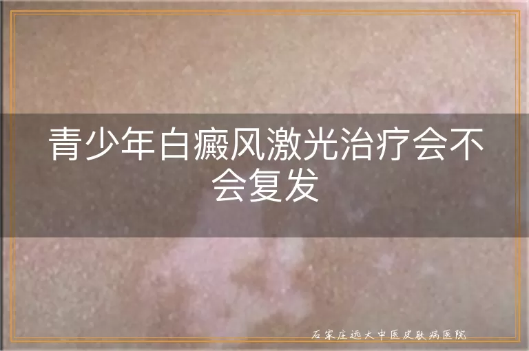 青少年白癜风激光治疗会不会复发