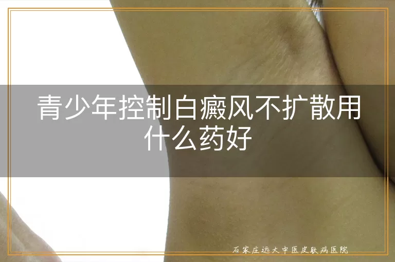 青少年控制白癜风不扩散用什么药好