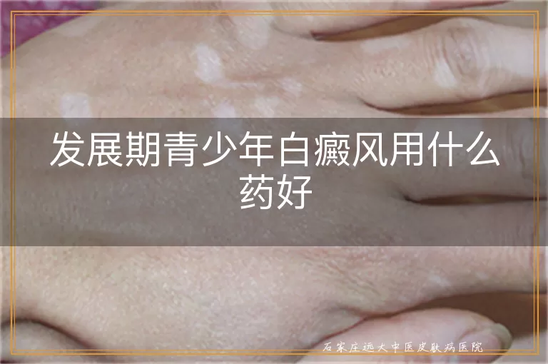 发展期青少年白癜风用什么药好