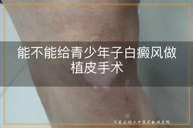 能不能给青少年子白癜风做植皮手术