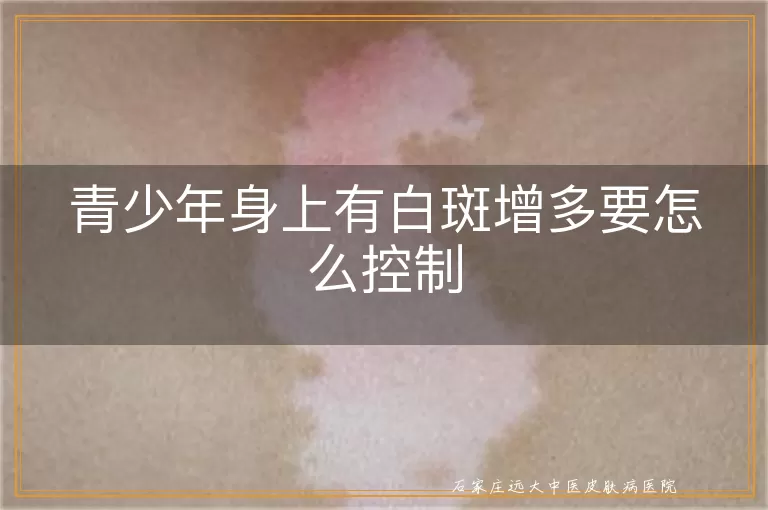 青少年身上有白斑增多要怎么控制
