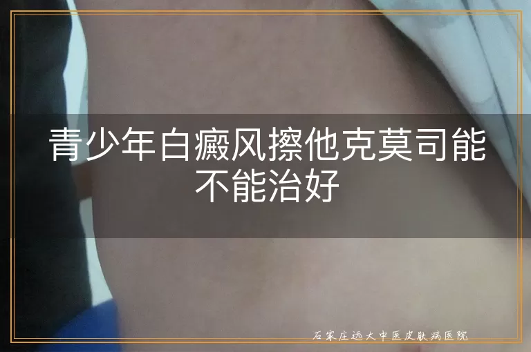 青少年白癜风擦他克莫司能不能治好