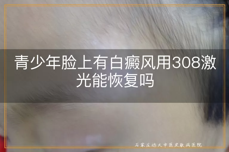 青少年脸上有白癜风用308激光能恢复吗
