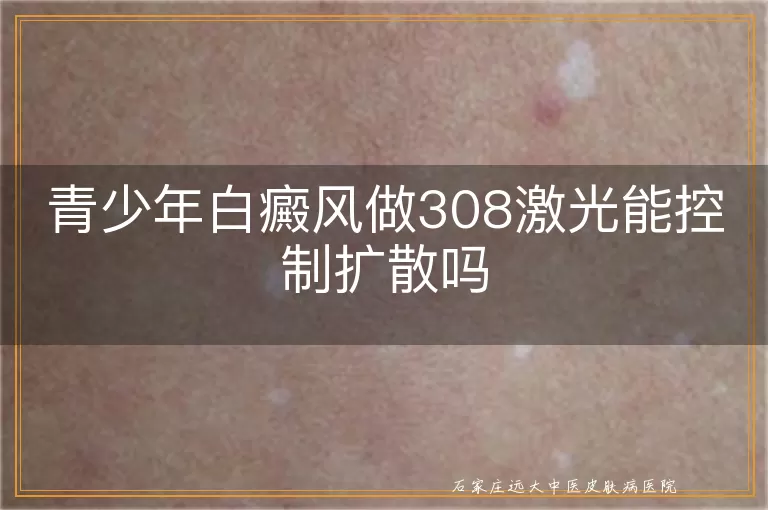 青少年白癜风做308激光能控制扩散吗