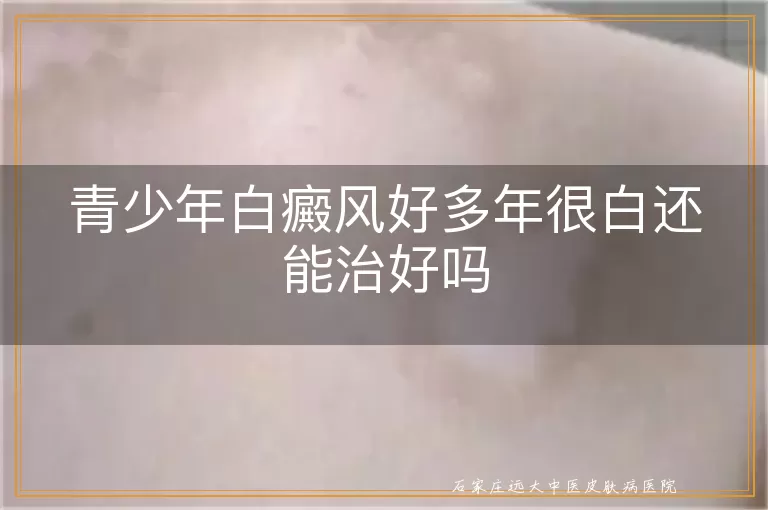 青少年白癜风好多年很白还能治好吗