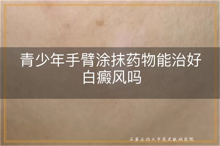 青少年手臂涂抹药物能治好白癜风吗