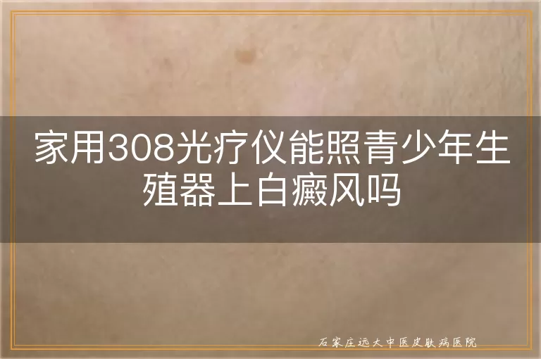 家用308光疗仪能照青少年生殖器上白癜风吗