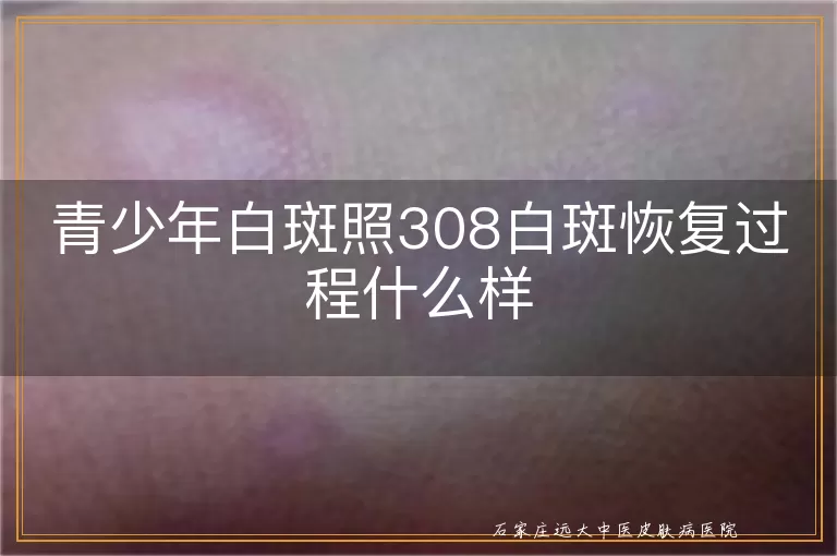 青少年白斑照308白斑恢复过程什么样