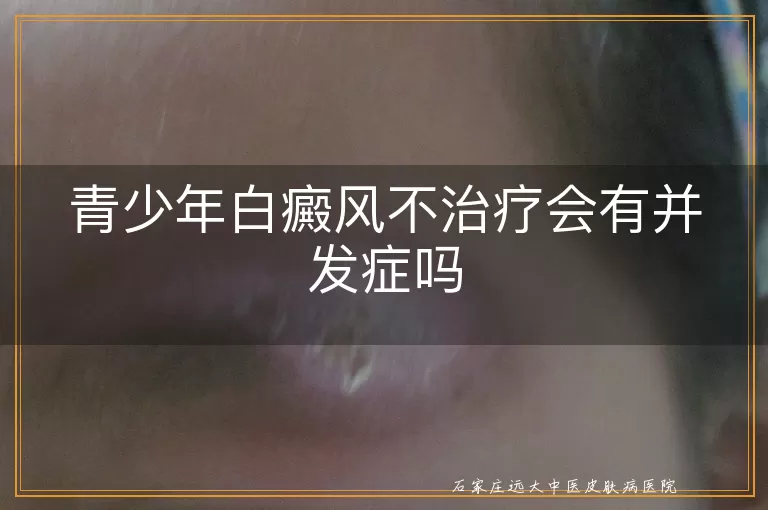 青少年白癜风不治疗会有并发症吗