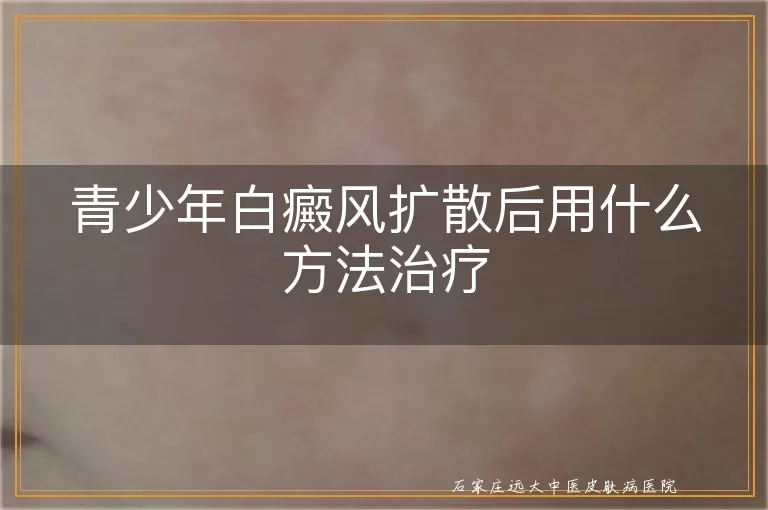 青少年白癜风扩散后用什么方法治疗