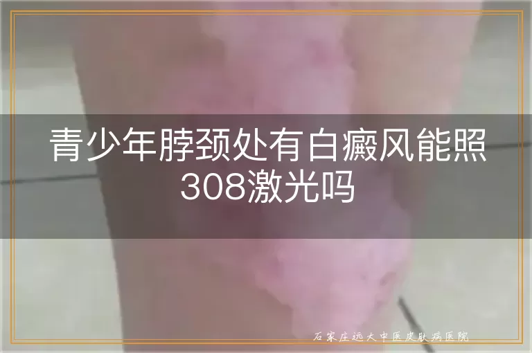 青少年脖颈处有白癜风能照308激光吗