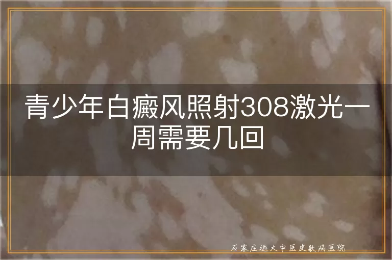 青少年白癜风照射308激光一周需要几回
