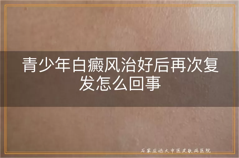 青少年白癜风治好后再次复发怎么回事