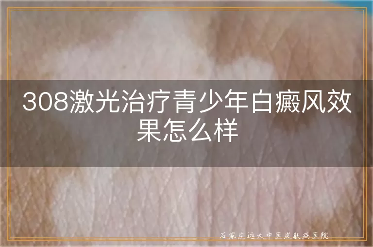 308激光治疗青少年白癜风效果怎么样