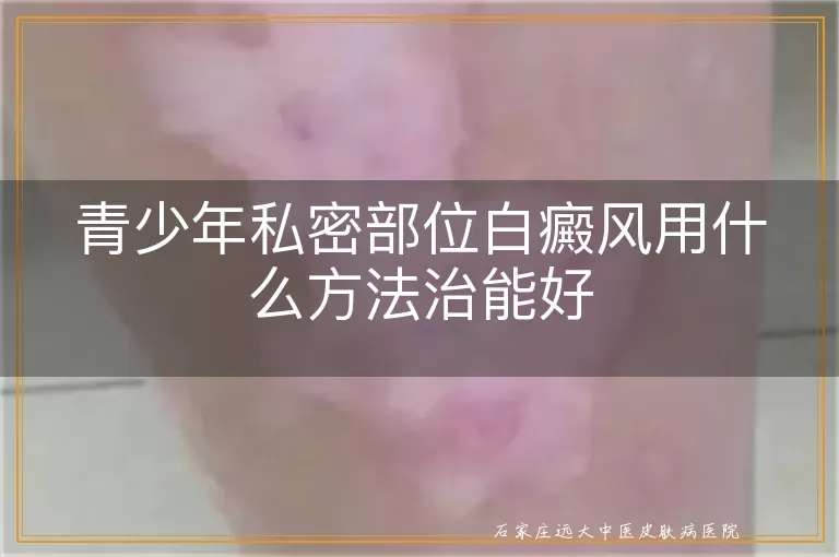 青少年私密部位白癜风用什么方法治能好