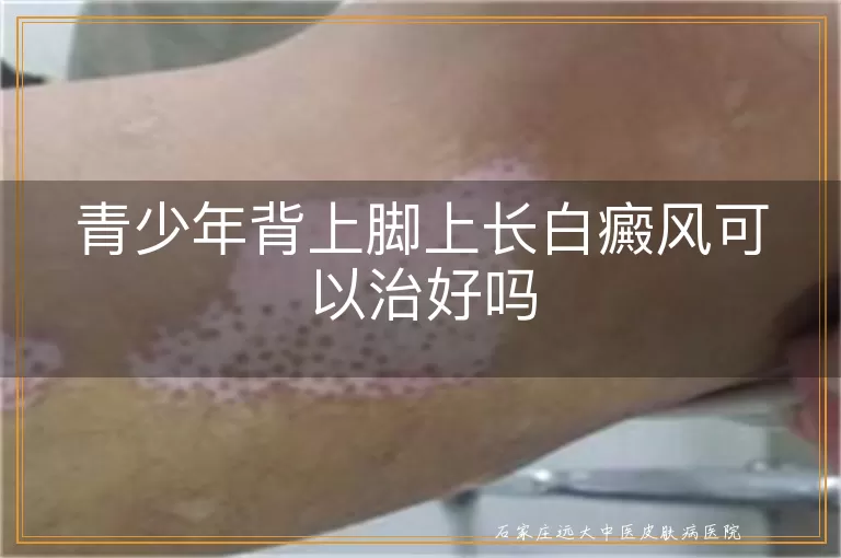 青少年背上脚上长白癜风可以治好吗
