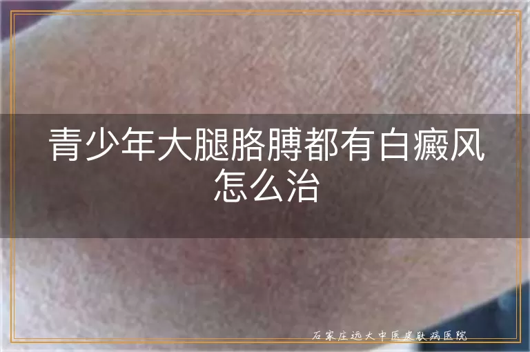 青少年大腿胳膊都有白癜风怎么治