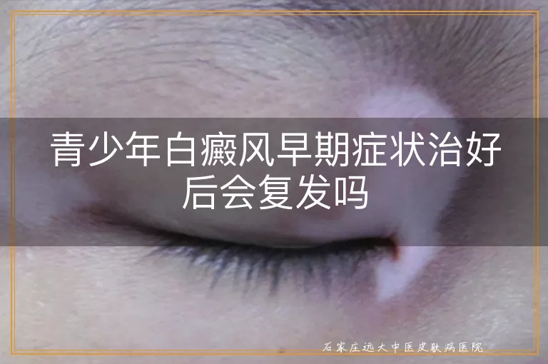 青少年白癜风早期症状治好后会复发吗
