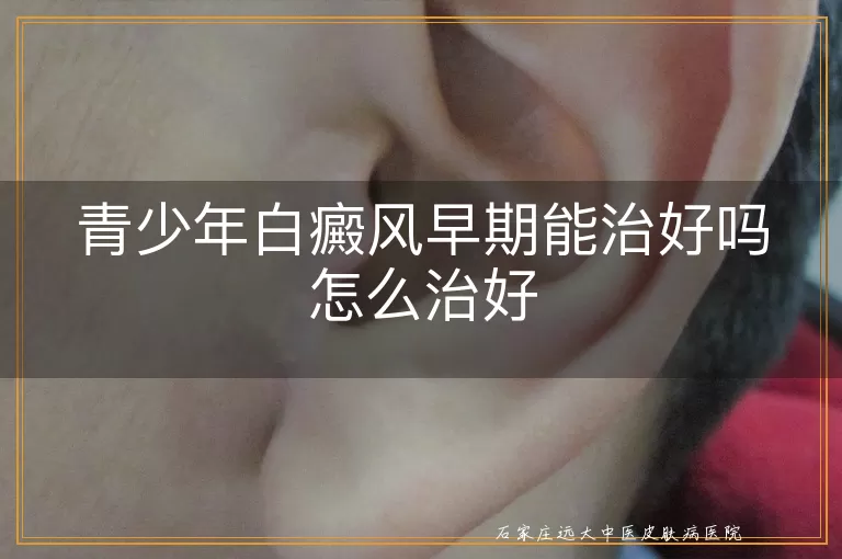 青少年白癜风早期能治好吗怎么治好