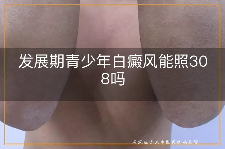 发展期青少年白癜风能照308吗