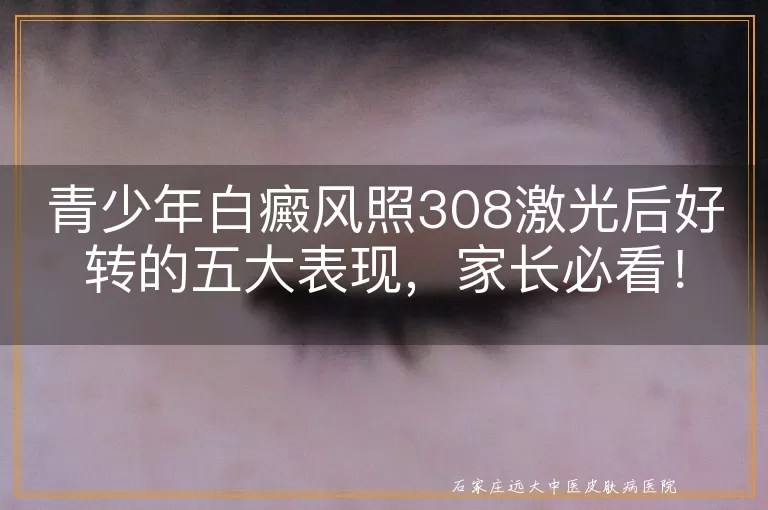 青少年白癜风照308激光后好转的五大表现，家长必看！