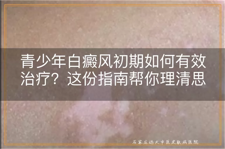 青少年白癜风初期如何有效治疗？这份指南帮你理清思路