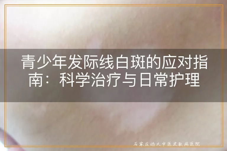 青少年发际线白斑的应对指南：科学治疗与日常护理