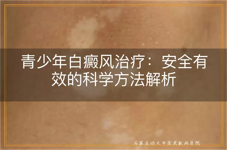 青少年白癜风治疗：安全有效的科学方法解析