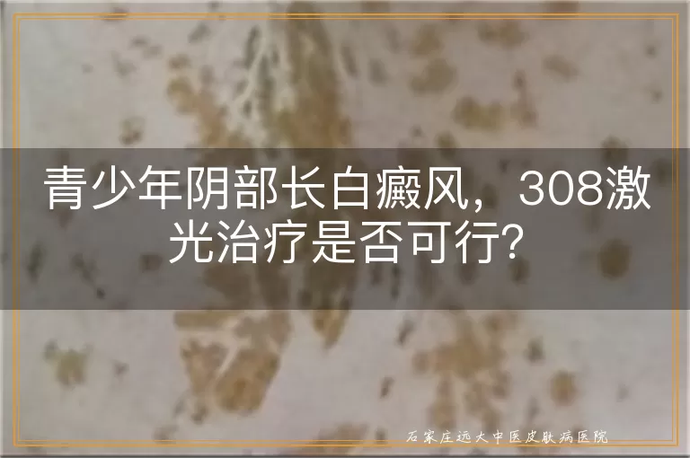 青少年阴部长白癜风，308激光治疗是否可行？