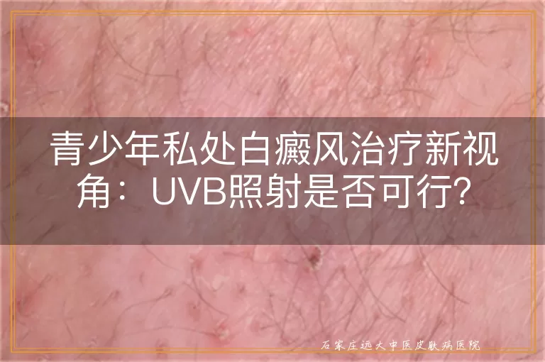青少年私处白癜风治疗新视角：UVB照射是否可行？