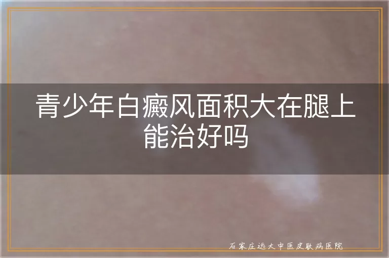 青少年白癜风面积大在腿上能治好吗