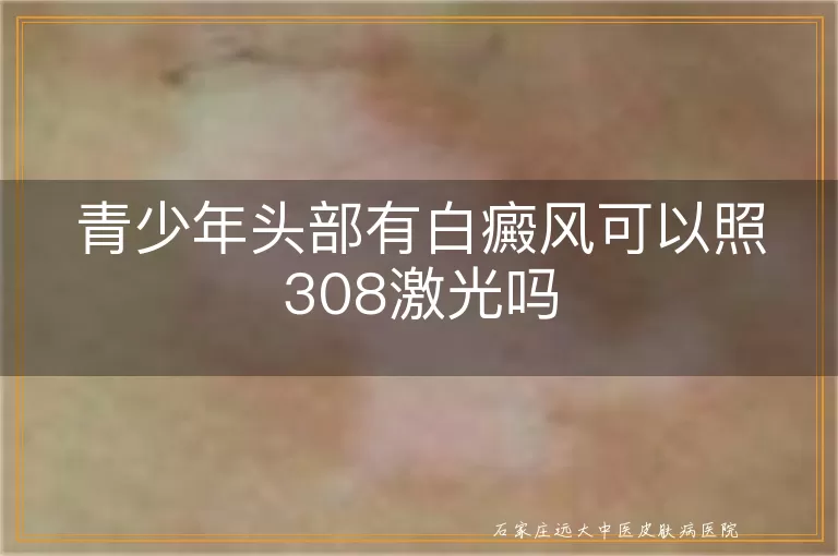 青少年头部有白癜风可以照308激光吗