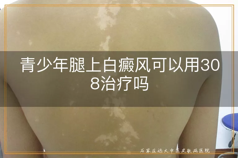 青少年腿上白癜风可以用308治疗吗