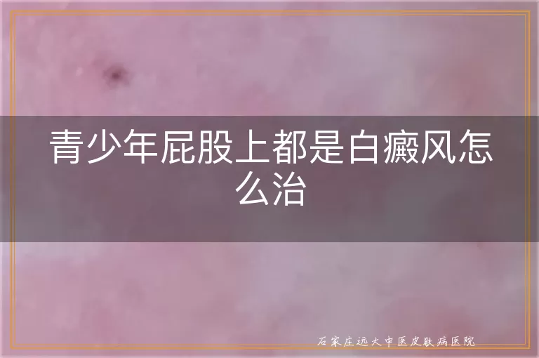 青少年屁股上都是白癜风怎么治