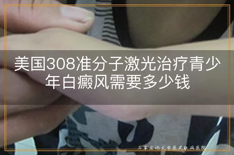 美国308准分子激光治疗青少年白癜风需要多少钱
