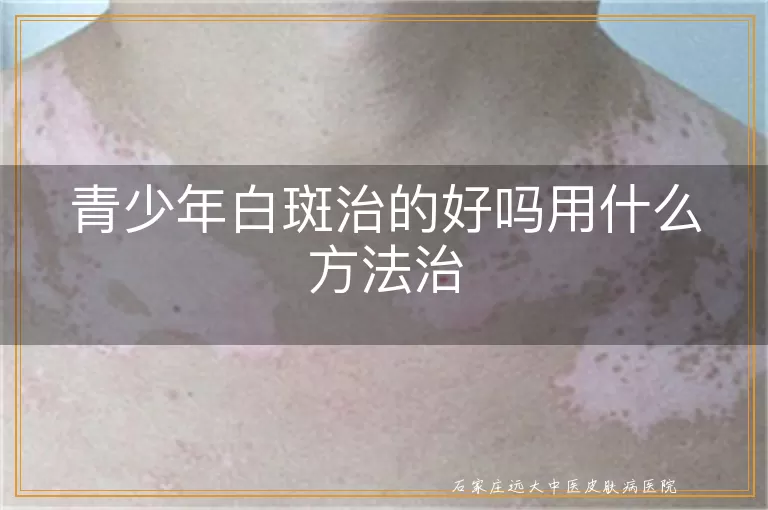 青少年白斑治的好吗用什么方法治