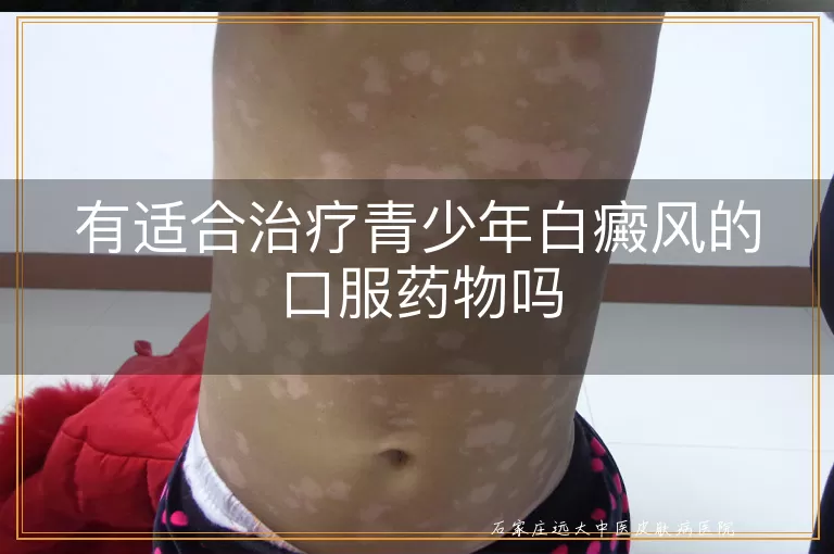 有适合治疗青少年白癜风的口服药物吗