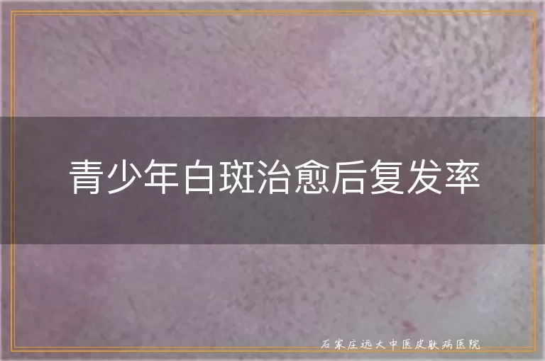 青少年白斑治愈后复发率