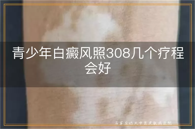 青少年白癜风照308几个疗程会好