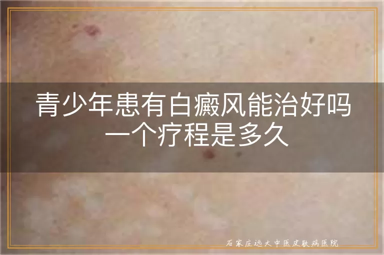 青少年患有白癜风能治好吗 一个疗程是多久