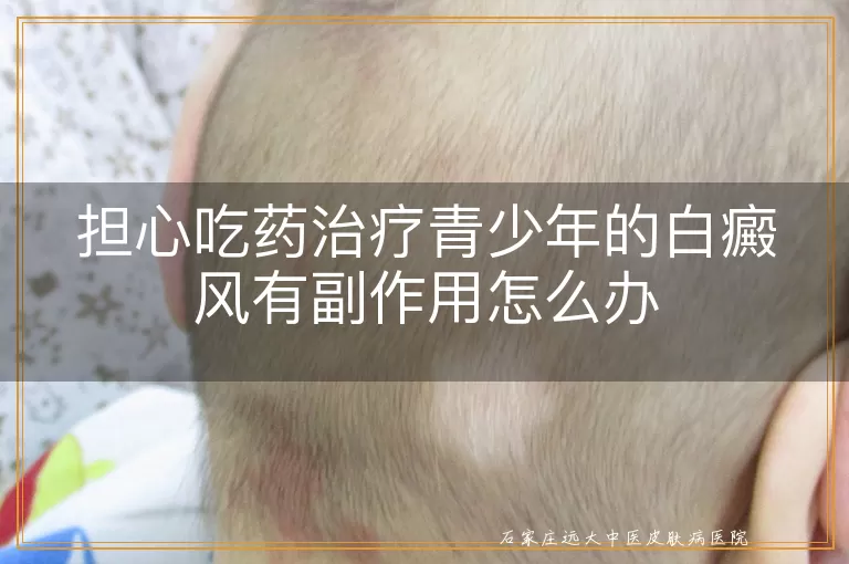 担心吃药治疗青少年的白癜风有副作用怎么办