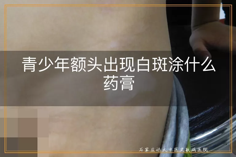 青少年额头出现白斑涂什么药膏